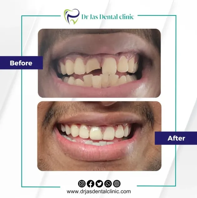 Before and after smile restoration at Dr Jas Dental Clinic, Pezhakkappilly